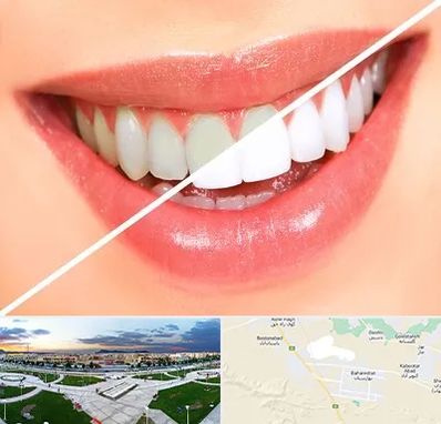 بلیچینگ دندان در بهارستان اصفهان