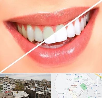 بلیچینگ دندان در شمیران نو