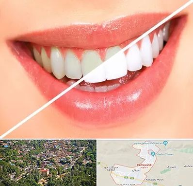 بلیچینگ دندان در دماوند