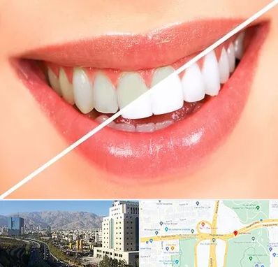 بلیچینگ دندان در حقانی