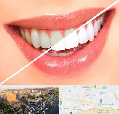 بلیچینگ دندان در تهرانپارس 