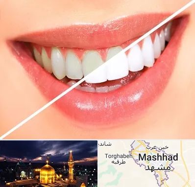 بلیچینگ دندان در مشهد