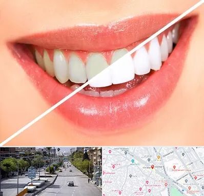 بلیچینگ دندان در خیابان زند شیراز