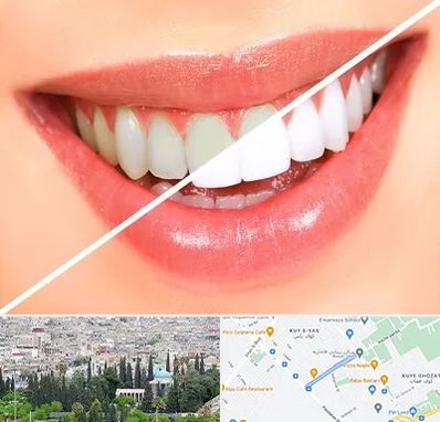 بلیچینگ دندان در محلاتی شیراز