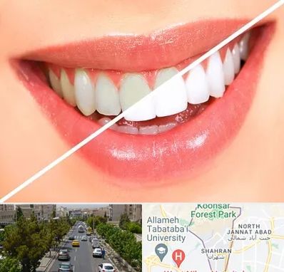 بلیچینگ دندان در شهران 