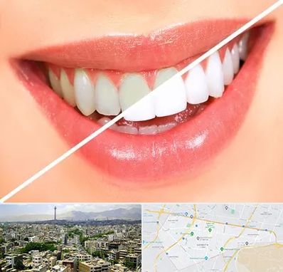 بلیچینگ دندان در منطقه 8 تهران