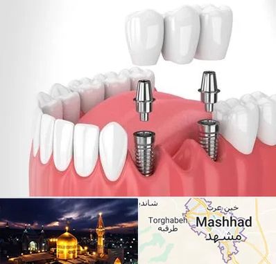 کاشت دندان در مشهد