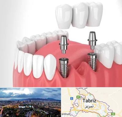 کاشت دندان در تبریز