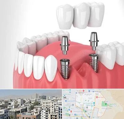 کاشت دندان در منطقه 14 تهران