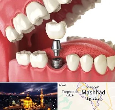 متخصص پروتز دندان در مشهد