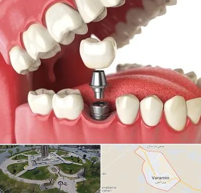 متخصص پروتز دندان در ورامین