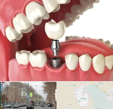 متخصص پروتز دندان در نظرآباد کرج
