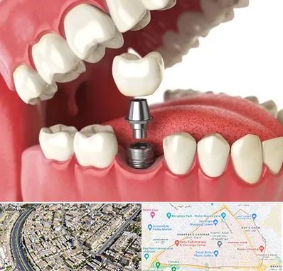 متخصص پروتز دندان در شهرک غرب مشهد