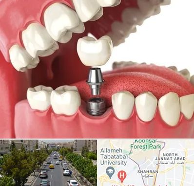متخصص پروتز دندان در شهران