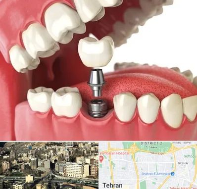 متخصص پروتز دندان در مرزداران