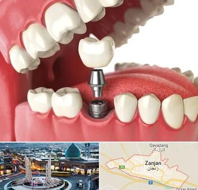 متخصص پروتز دندان در زنجان