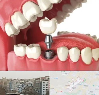 متخصص پروتز دندان در محمد شهر کرج