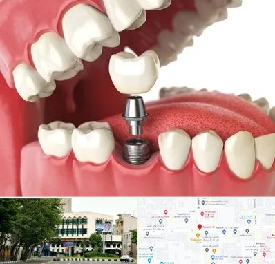 متخصص پروتز دندان در طالقانی