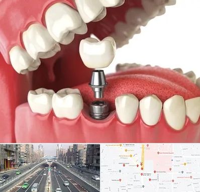متخصص پروتز دندان در توحید