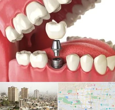 متخصص پروتز دندان در منطقه 5 تهران