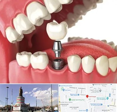 متخصص پروتز دندان در کارگر جنوبی
