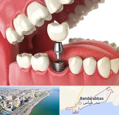 متخصص پروتز دندان در بندرعباس
