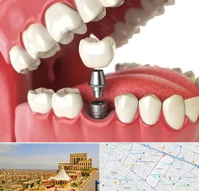 متخصص پروتز دندان در هاشمیه مشهد