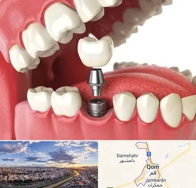 متخصص پروتز دندان در قم