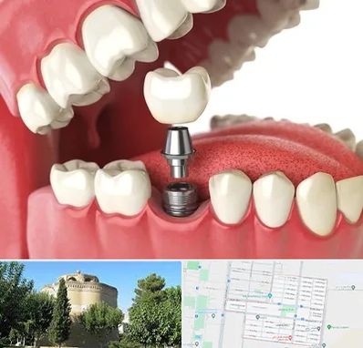 متخصص پروتز دندان در مرداویج اصفهان