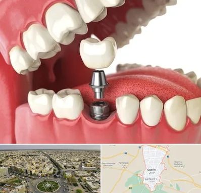 متخصص پروتز دندان در قزوین