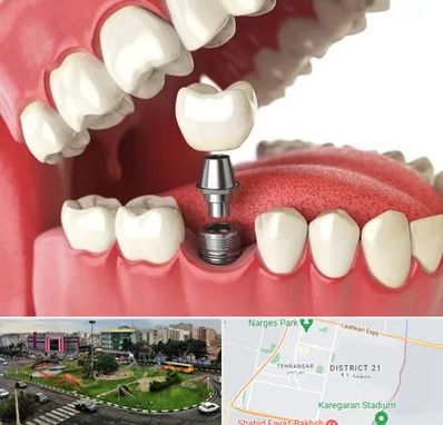 متخصص پروتز دندان در تهرانسر