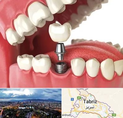 متخصص پروتز دندان در تبریز