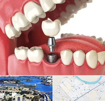 متخصص پروتز دندان در کوروش اهواز