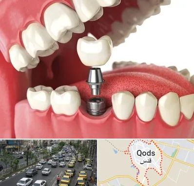 متخصص پروتز دندان در شهر قدس