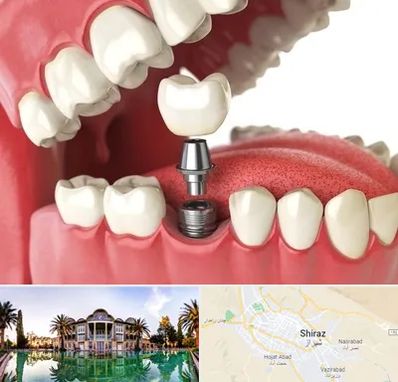 متخصص پروتز دندان در شیراز