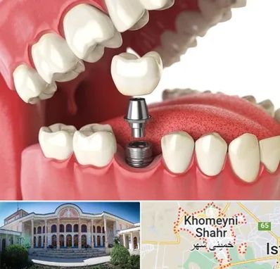متخصص پروتز دندان در خمینی شهر