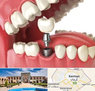 متخصص پروتز دندان در کرمان