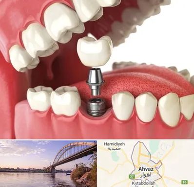 متخصص پروتز دندان در اهواز