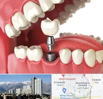 متخصص پروتز دندان در شهرک غرب