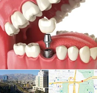 متخصص پروتز دندان در حقانی