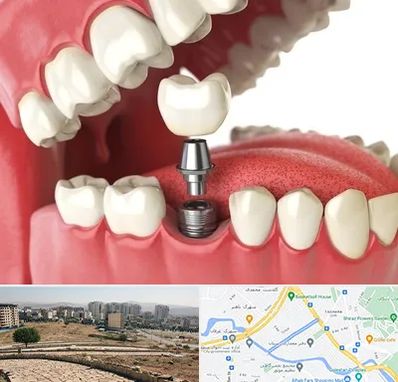 متخصص پروتز دندان در کوی وحدت شیراز