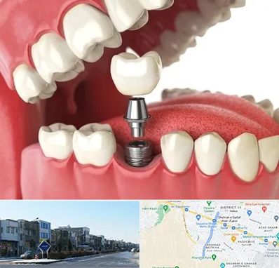 متخصص پروتز دندان در شریعتی مشهد