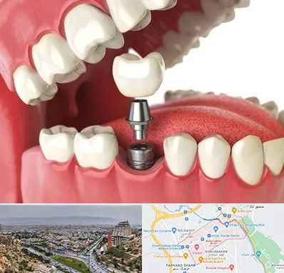 متخصص پروتز دندان در معالی آباد شیراز