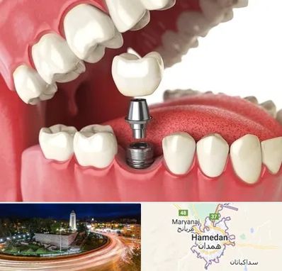 متخصص پروتز دندان در همدان