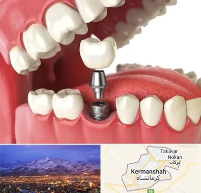 متخصص پروتز دندان در کرمانشاه