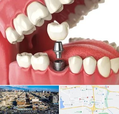 متخصص پروتز دندان در شهرک راه آهن