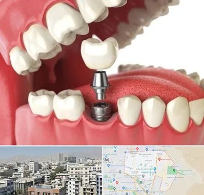 متخصص پروتز دندان در منطقه 14 تهران