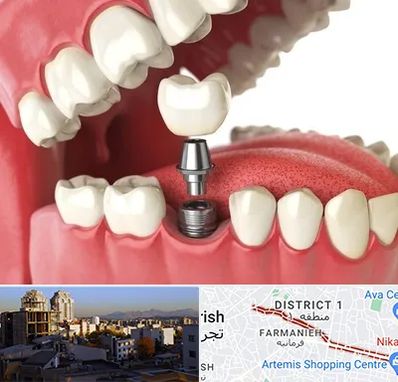متخصص پروتز دندان در فرمانیه