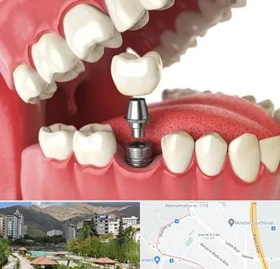 متخصص پروتز دندان در شهر زیبا