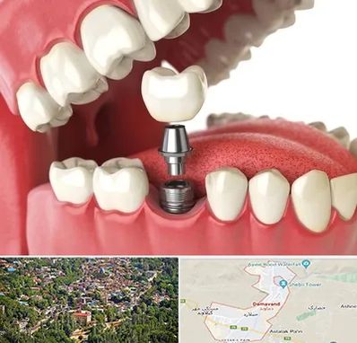 متخصص پروتز دندان در دماوند